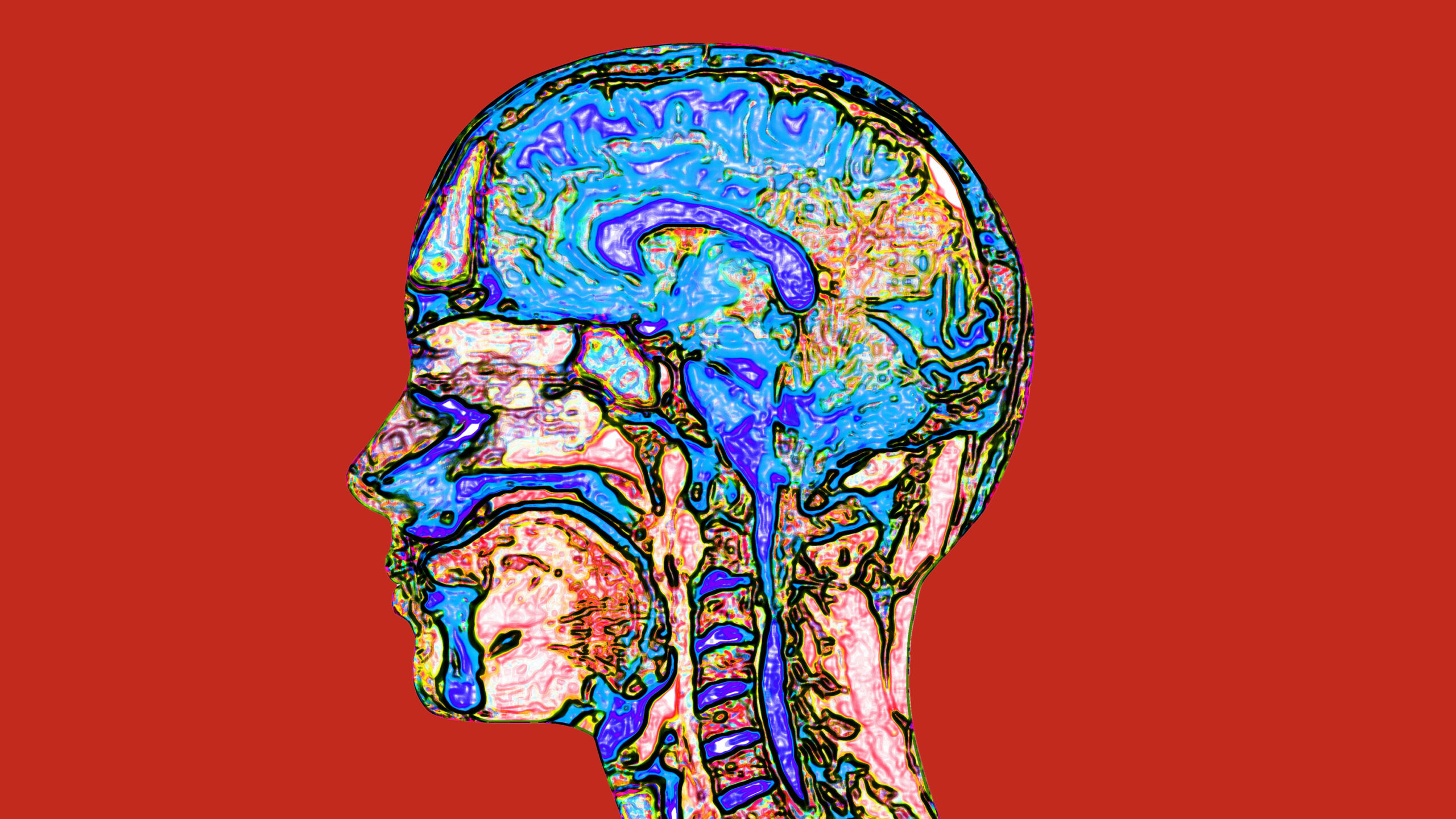 Image: Brain and Spinal Cord, MRI representing adult ADHD.